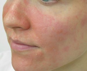 Homeopathy treatment for eczema
