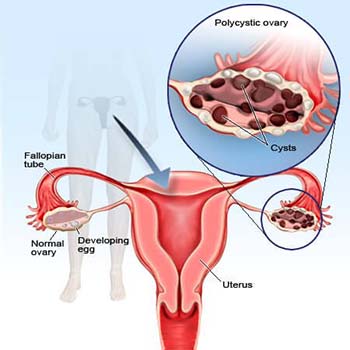 Polycystic Ovarian Syndrome (PCOS)
