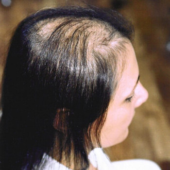 ladies-baldness